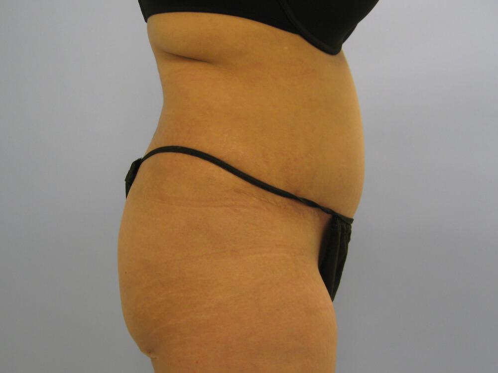 Buttocks Reshaping Before & After Image
