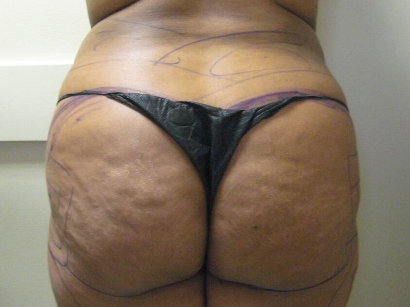 Buttocks Reshaping Before & After Image