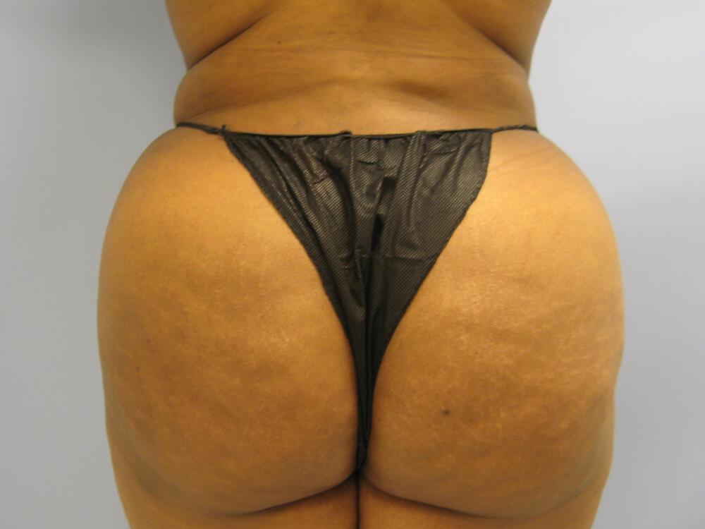 Buttocks Reshaping Before & After Image
