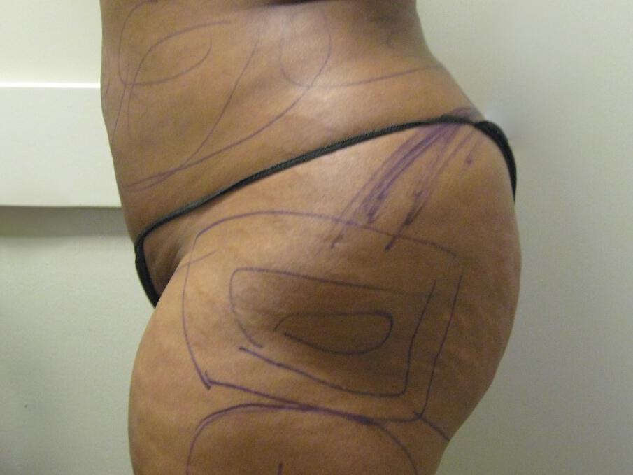 Buttocks Reshaping Before & After Image