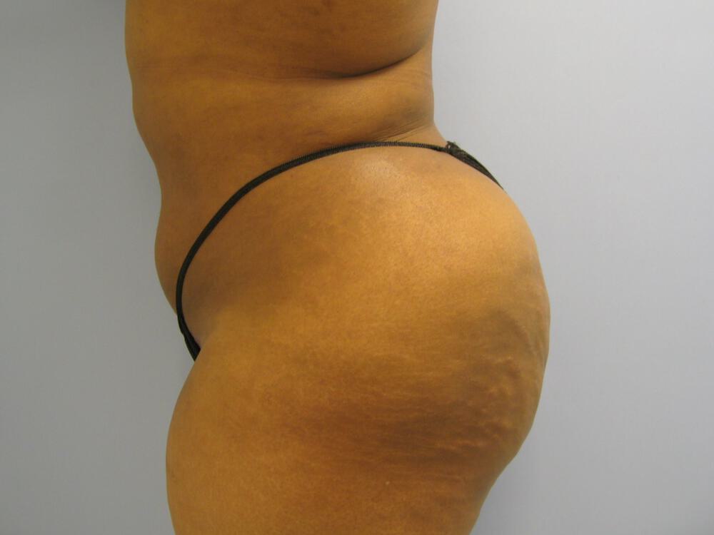 Buttocks Reshaping Before & After Image