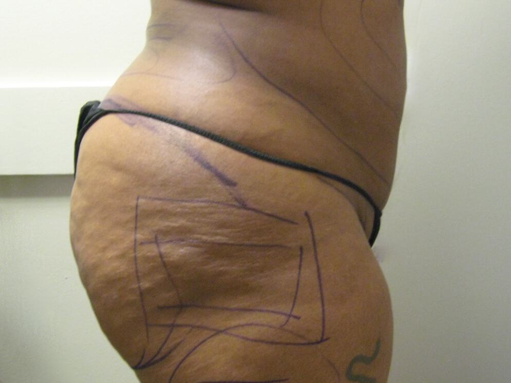 Buttocks Reshaping Before & After Image