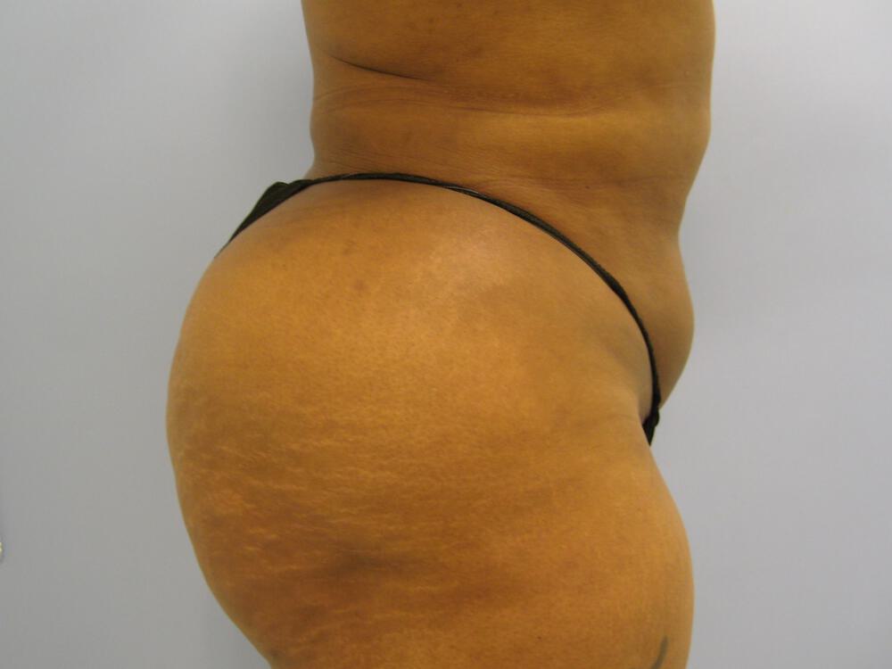 Buttocks Reshaping Before & After Image