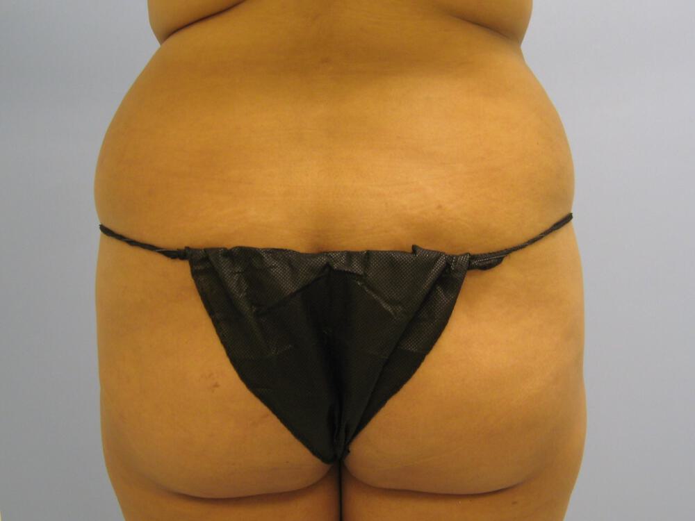 Buttocks Reshaping Before & After Image