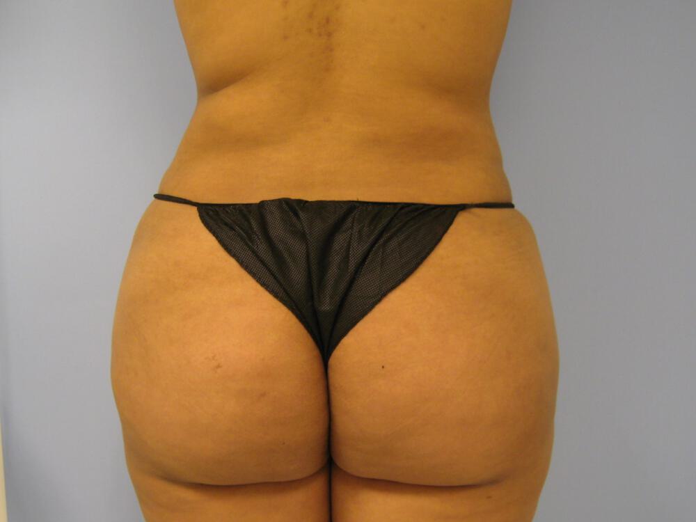 Buttocks Reshaping Before & After Image