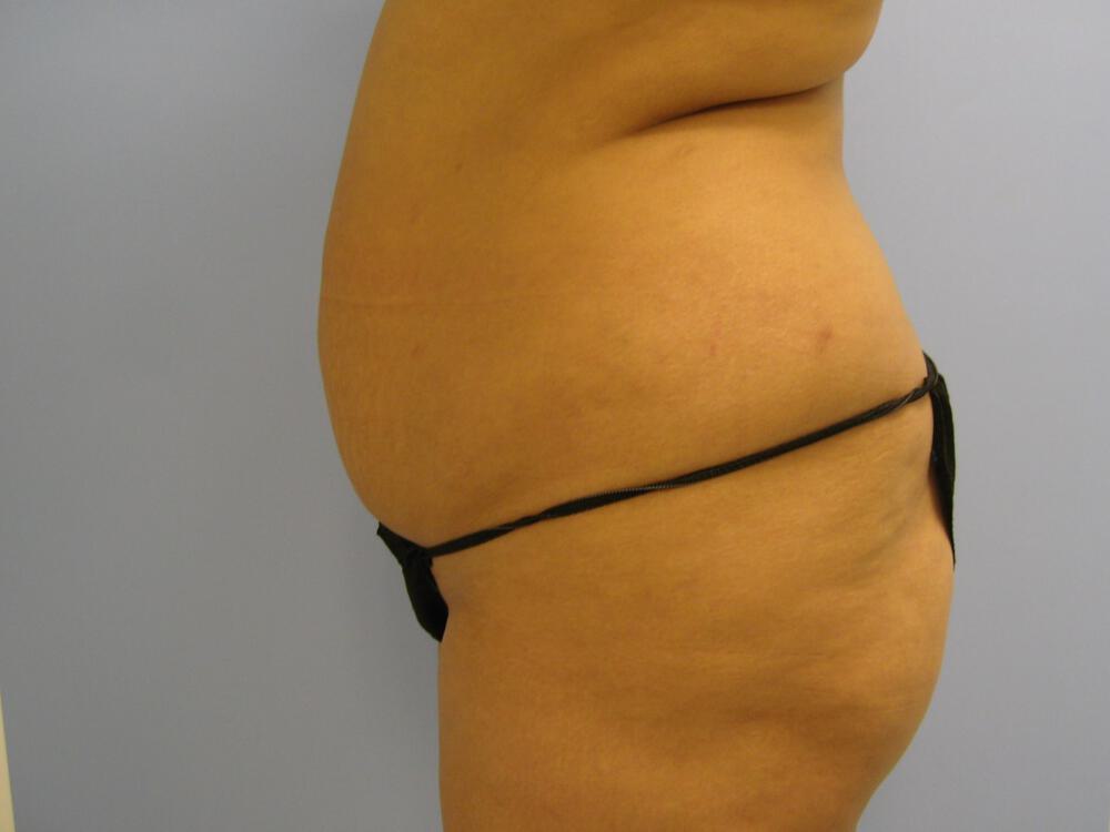 Buttocks Reshaping Before & After Image