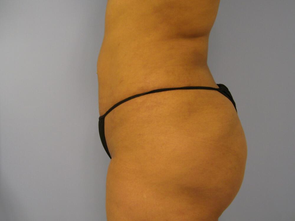 Buttocks Reshaping Before & After Image