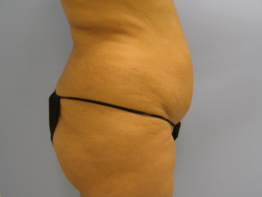 Buttocks Reshaping Before & After Image