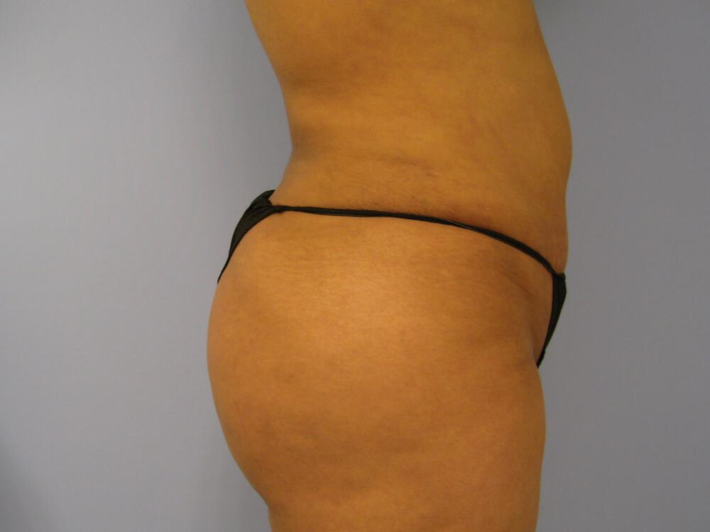 Buttocks Reshaping Before & After Image