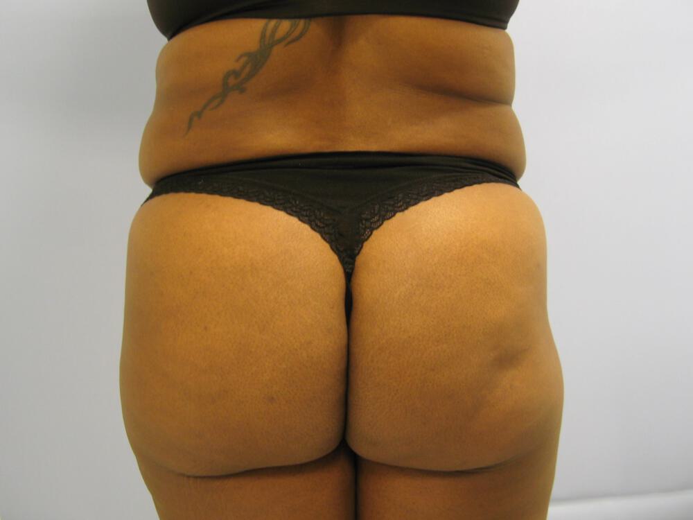 Buttocks Reshaping Before & After Image
