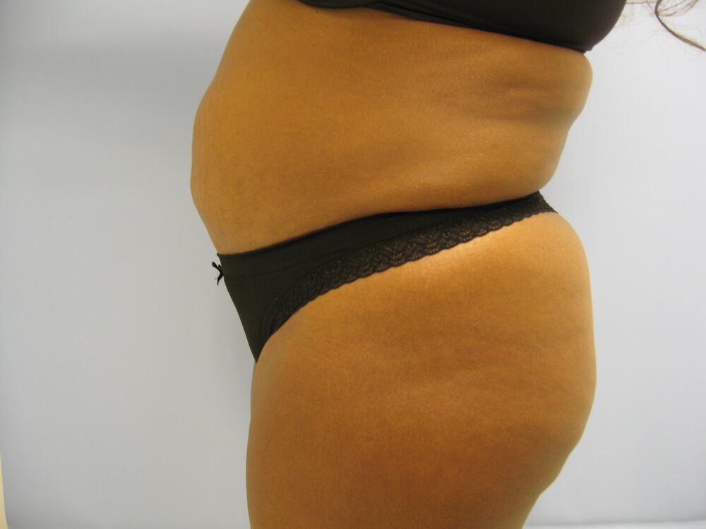 Buttocks Reshaping Before & After Image