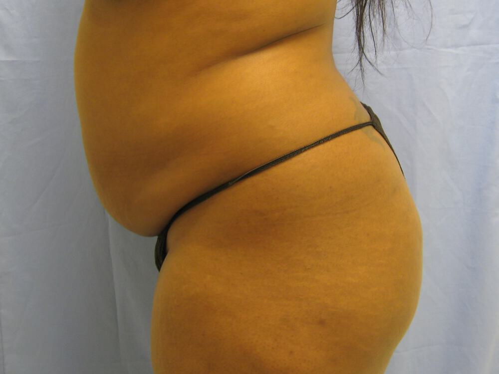 Buttocks Reshaping Before & After Image