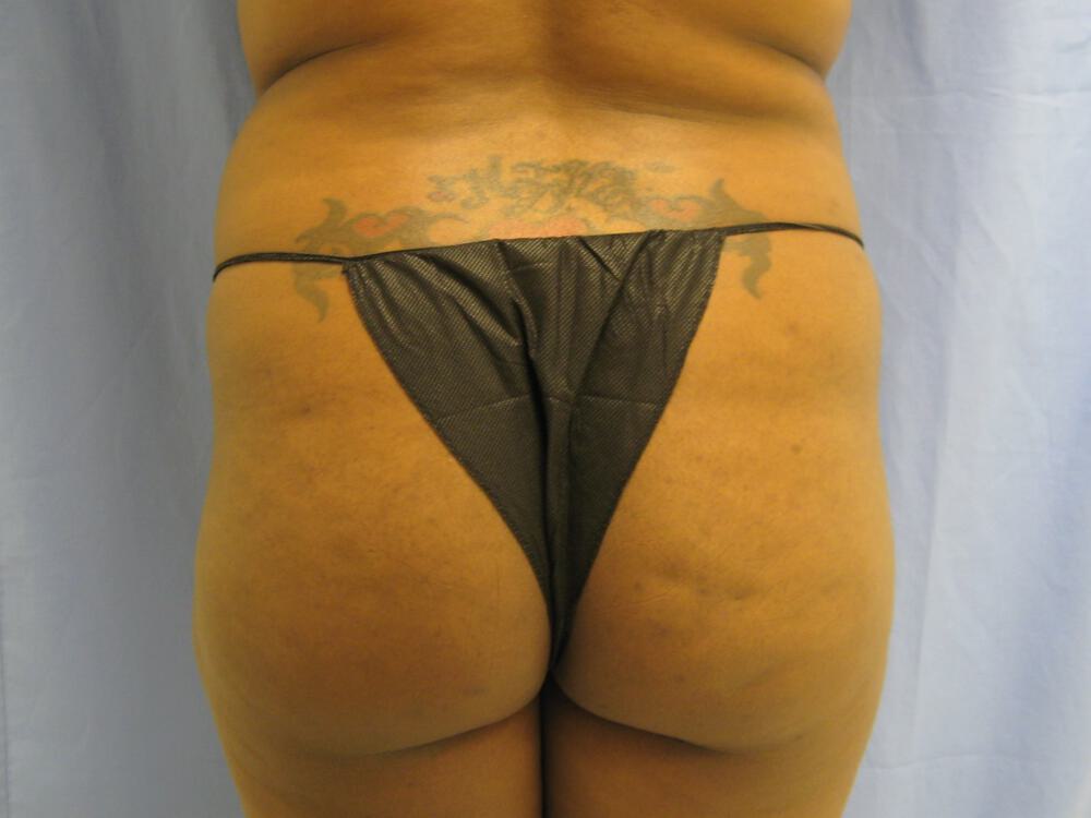 Buttocks Reshaping Before & After Image