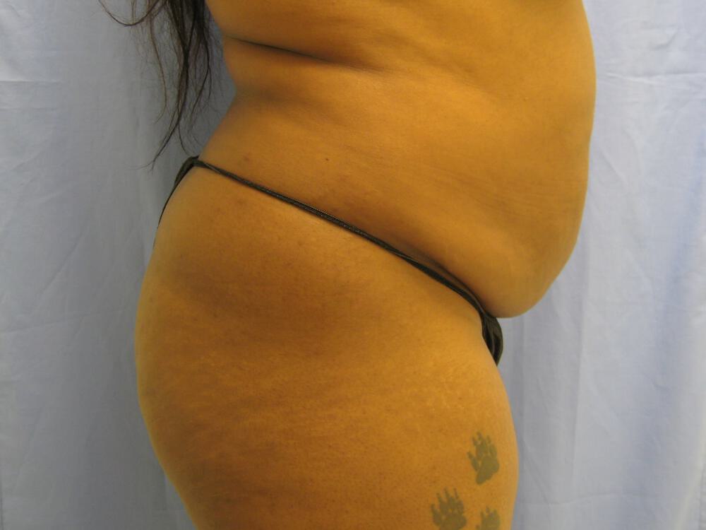 Buttocks Reshaping Before & After Image