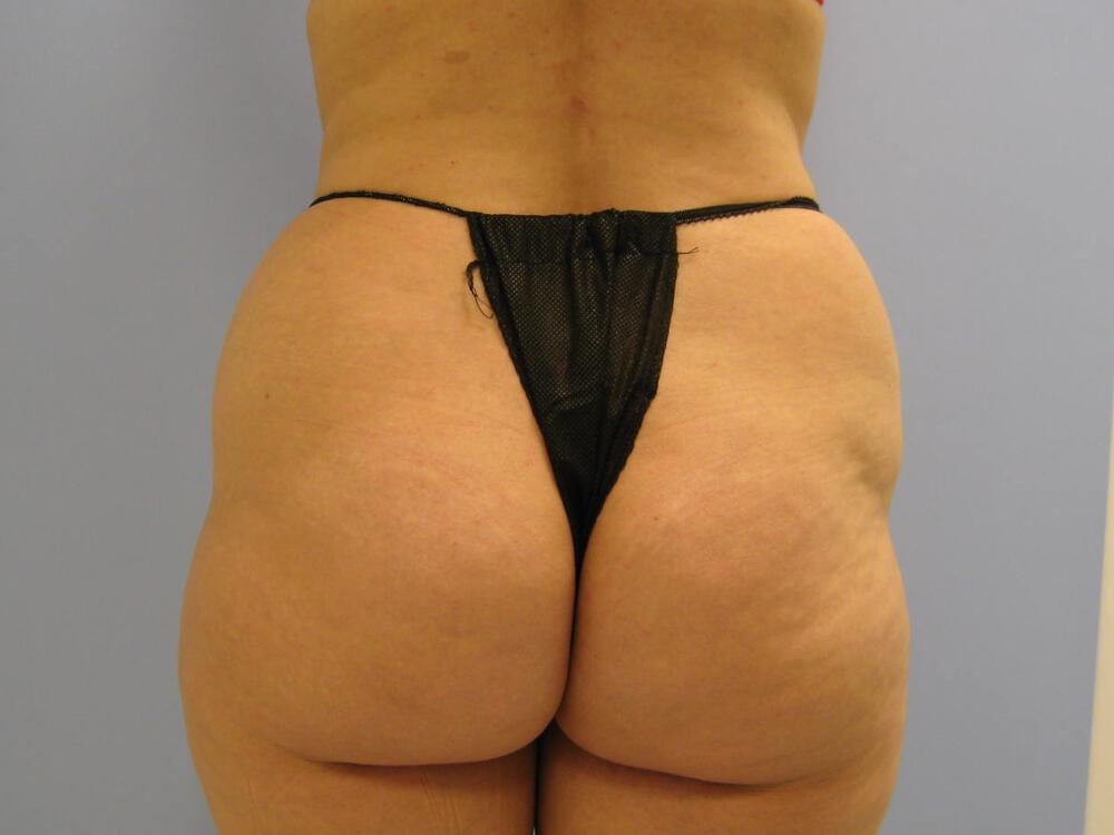 Buttocks Reshaping Before & After Image