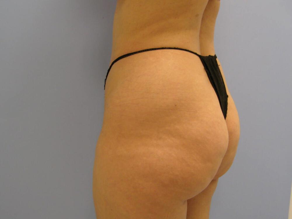 Buttocks Reshaping Before & After Image
