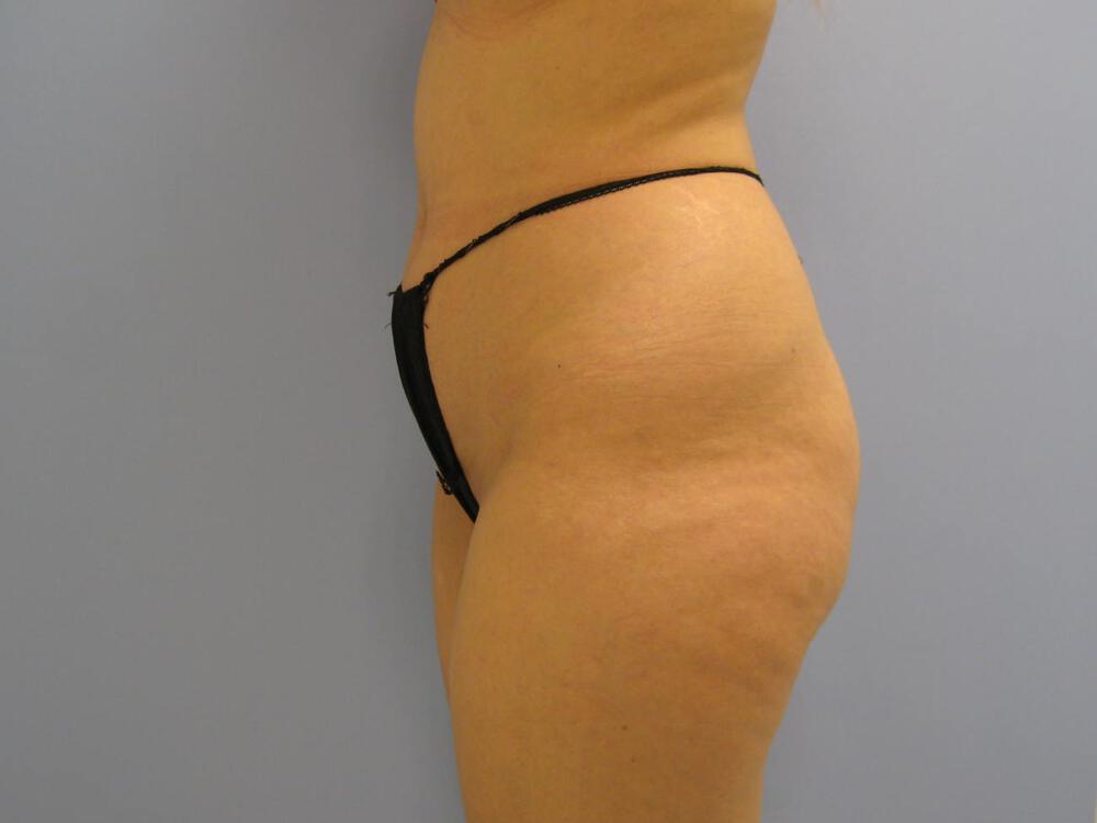 Buttocks Reshaping Before & After Image