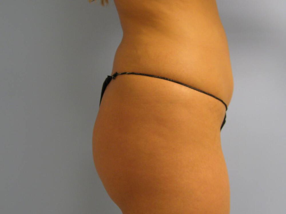 Buttocks Reshaping Before & After Image