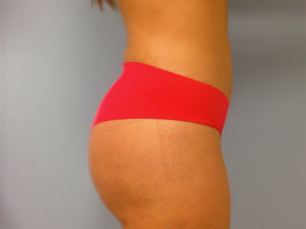 Buttocks Reshaping Before & After Image