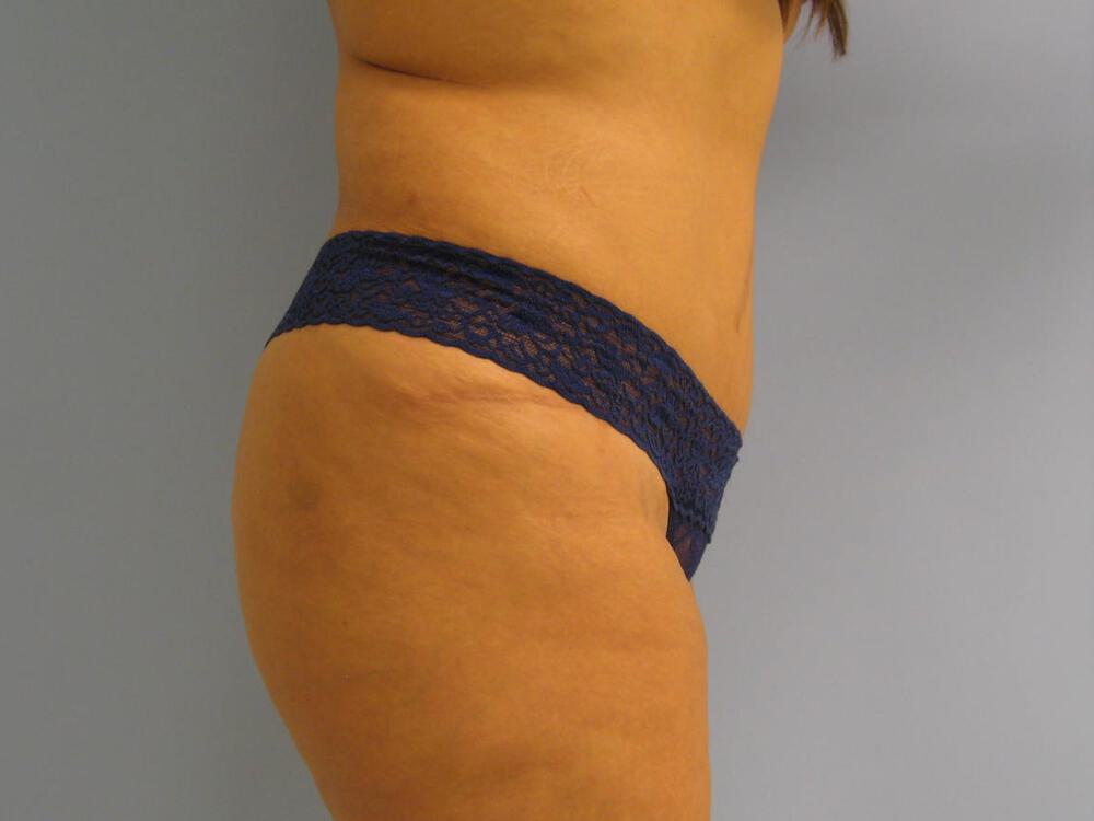 Buttocks Reshaping Before & After Image