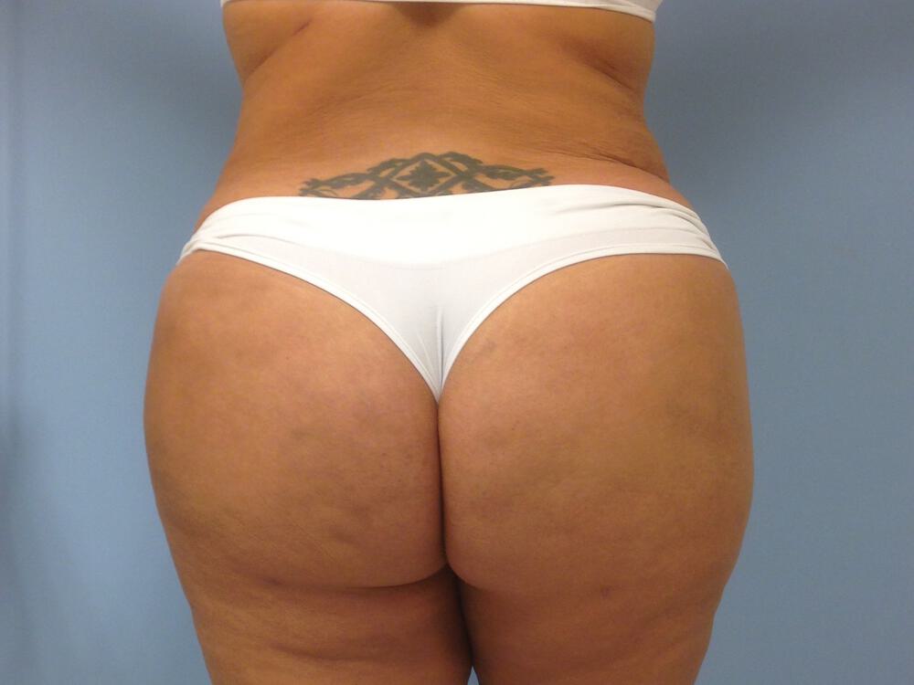 Buttocks Reshaping Before & After Image