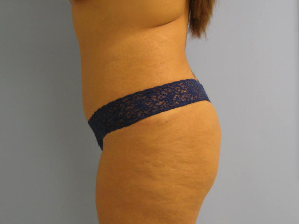 Buttocks Reshaping Before & After Image