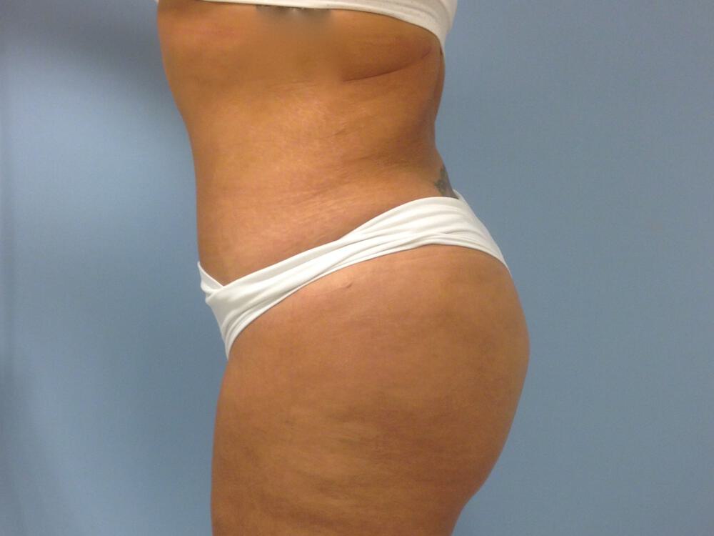 Buttocks Reshaping Before & After Image