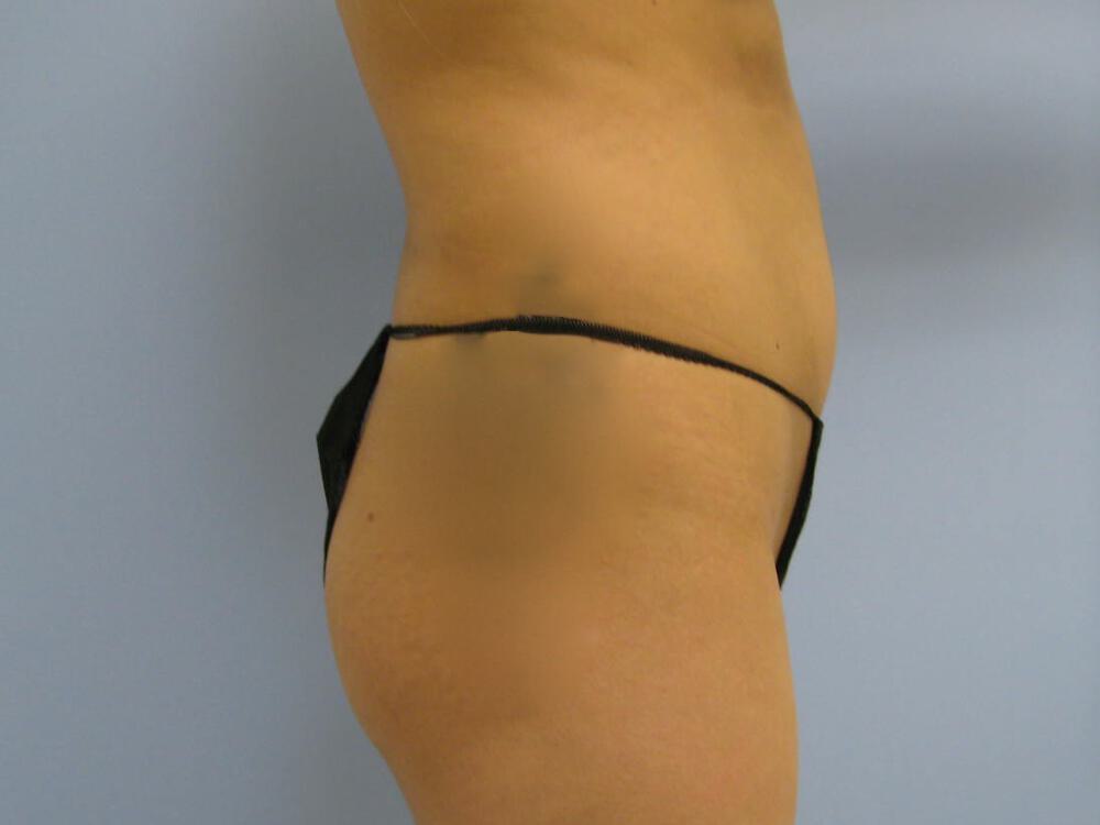 Buttocks Reshaping Before & After Image