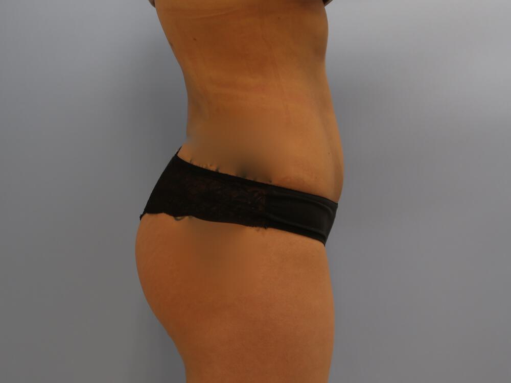 Buttocks Reshaping Before & After Image
