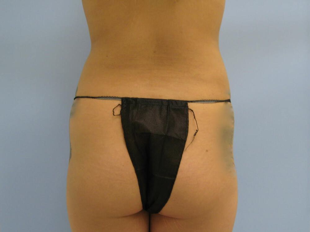 Buttocks Reshaping Before & After Image