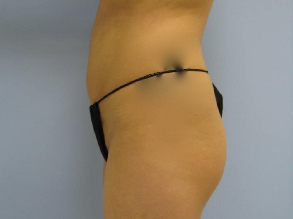 Buttocks Reshaping Before & After Image