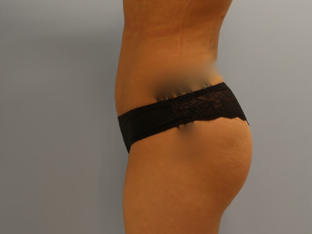 Buttocks Reshaping Before & After Image