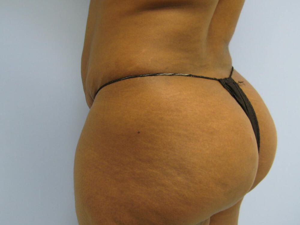 Buttocks Reshaping Before & After Image