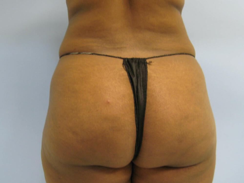 Buttocks Reshaping Before & After Image