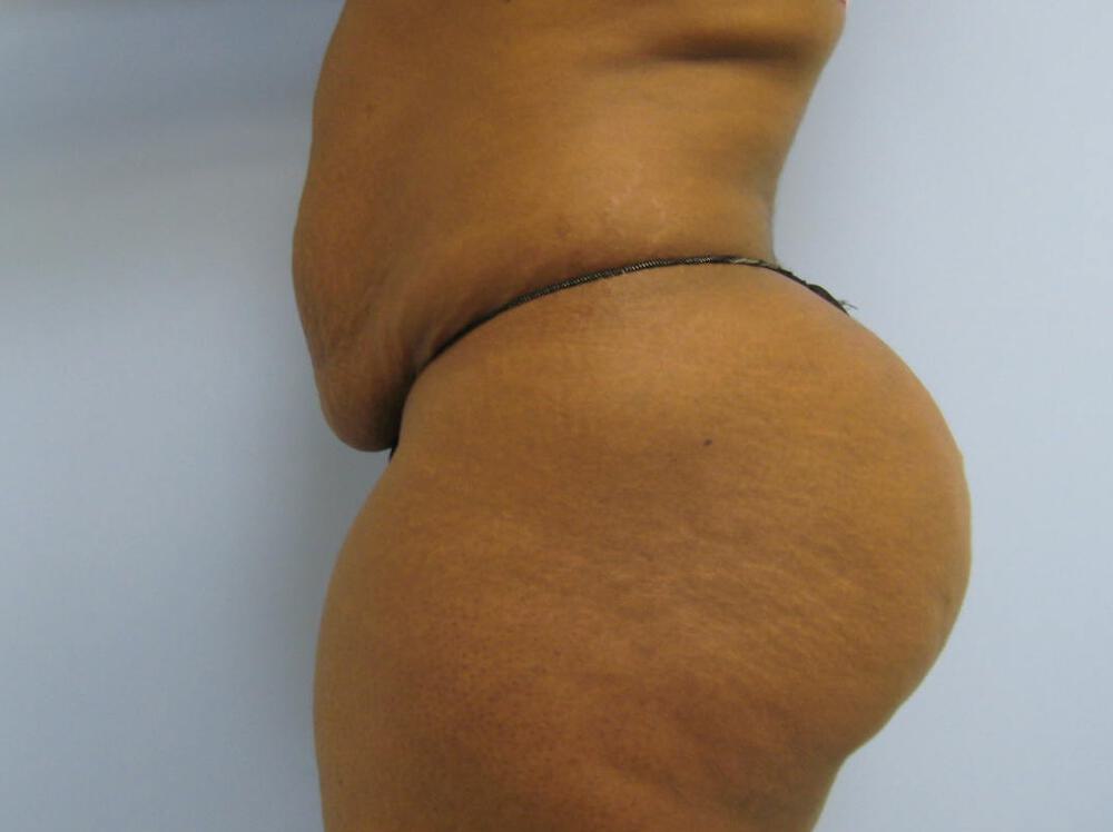 Buttocks Reshaping Before & After Image