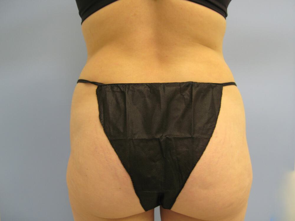 Buttocks Reshaping Before & After Image