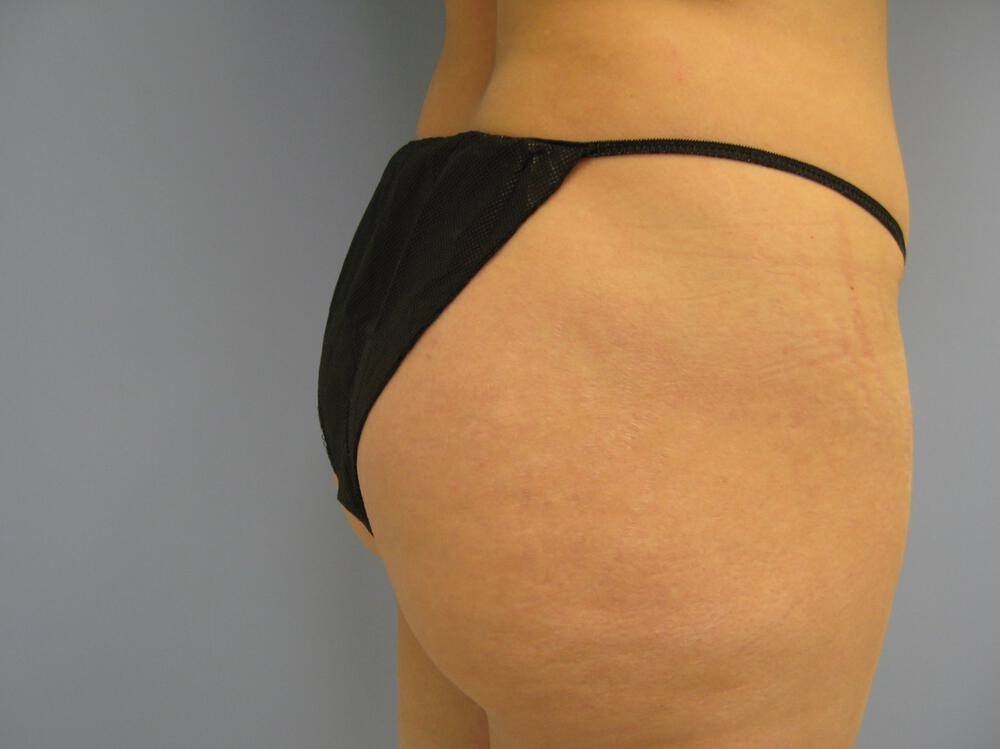 Buttocks Reshaping Before & After Image