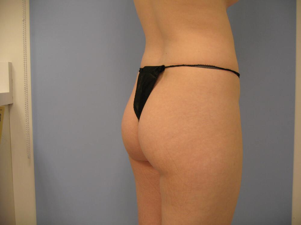 Buttocks Reshaping Before & After Image