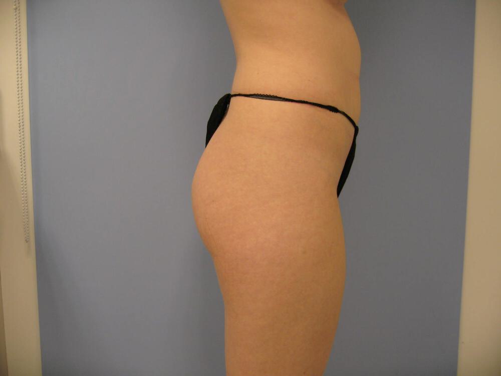 Buttocks Reshaping Before & After Image