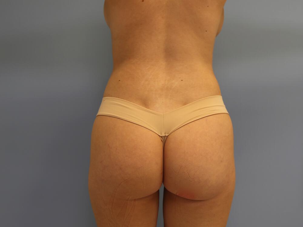 Buttocks Reshaping Before & After Image
