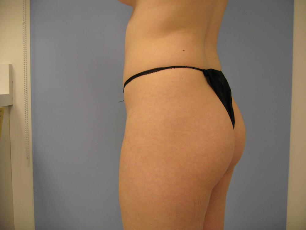 Buttocks Reshaping Before & After Image
