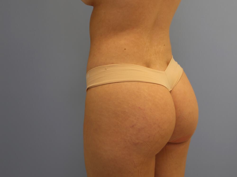 Buttocks Reshaping Before & After Image