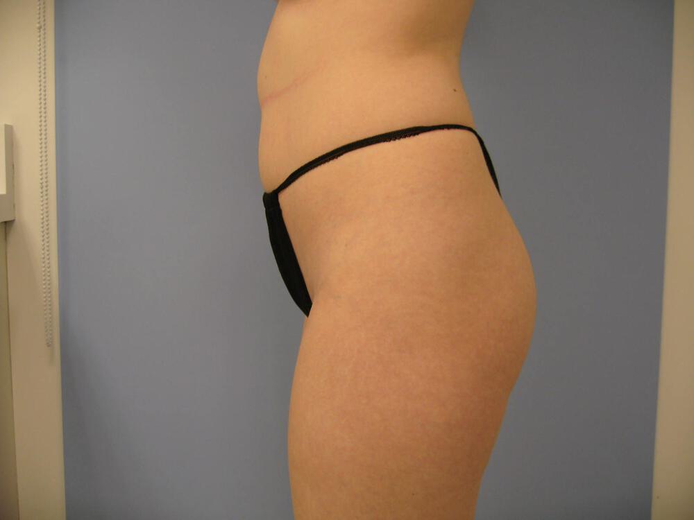 Buttocks Reshaping Before & After Image