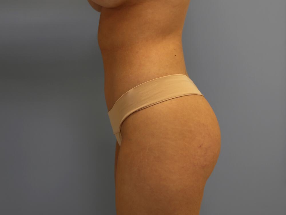 Buttocks Reshaping Before & After Image
