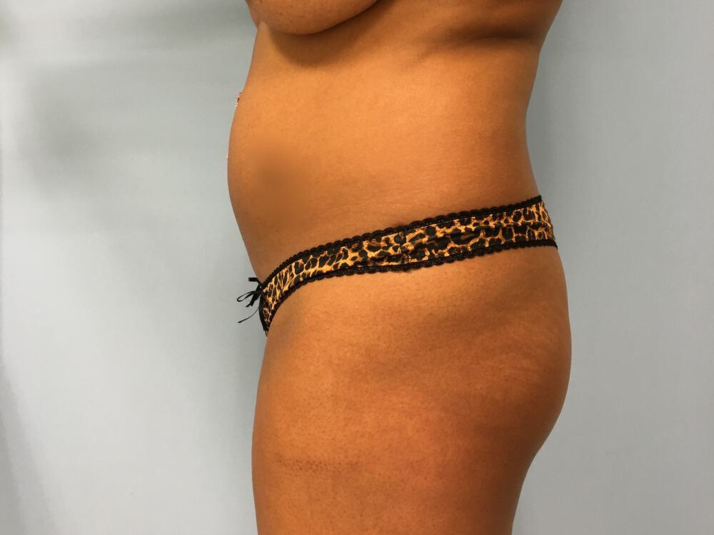 Buttocks Reshaping Before & After Image