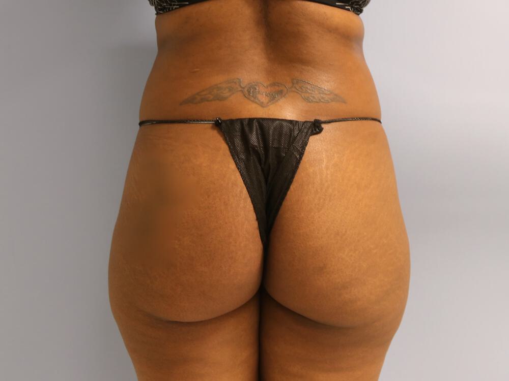 Buttocks Reshaping Before & After Image