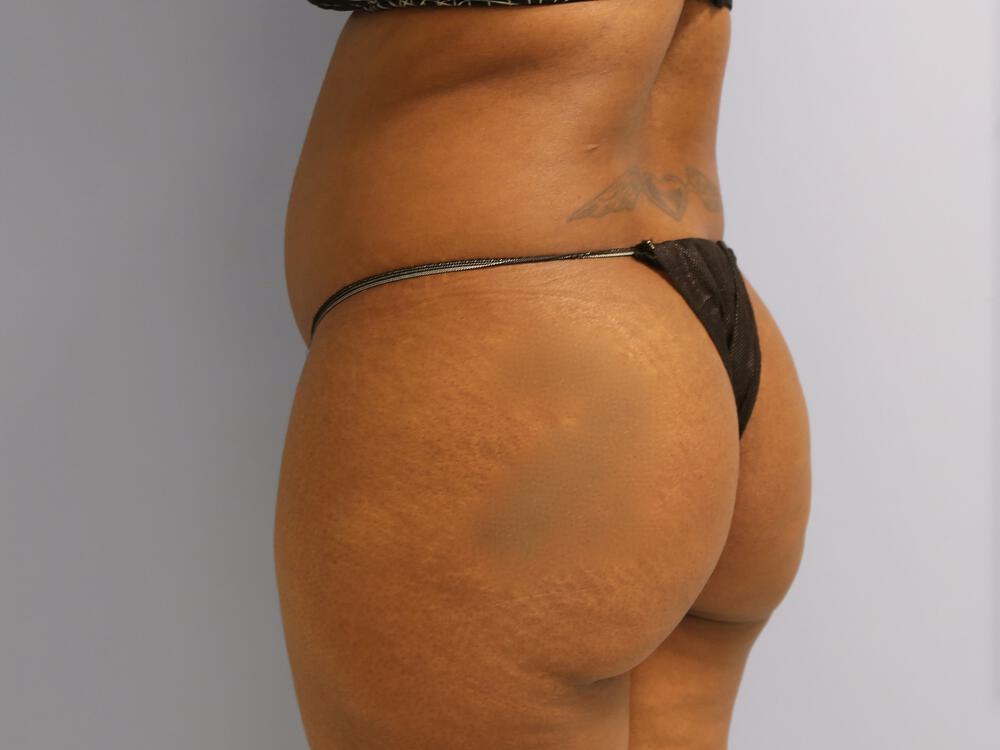 Buttocks Reshaping Before & After Image