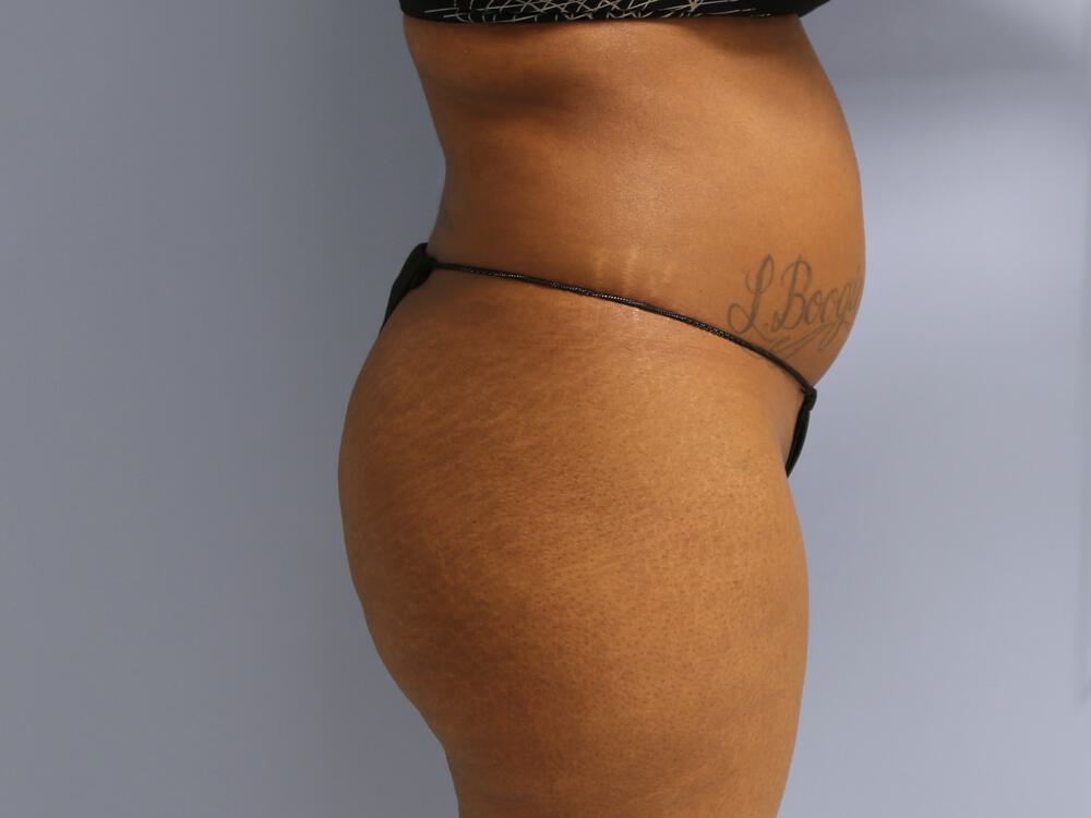 Buttocks Reshaping Before & After Image