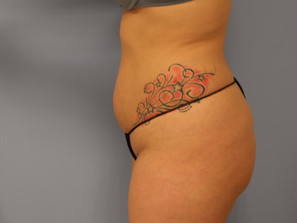 Buttocks Reshaping Before & After Image