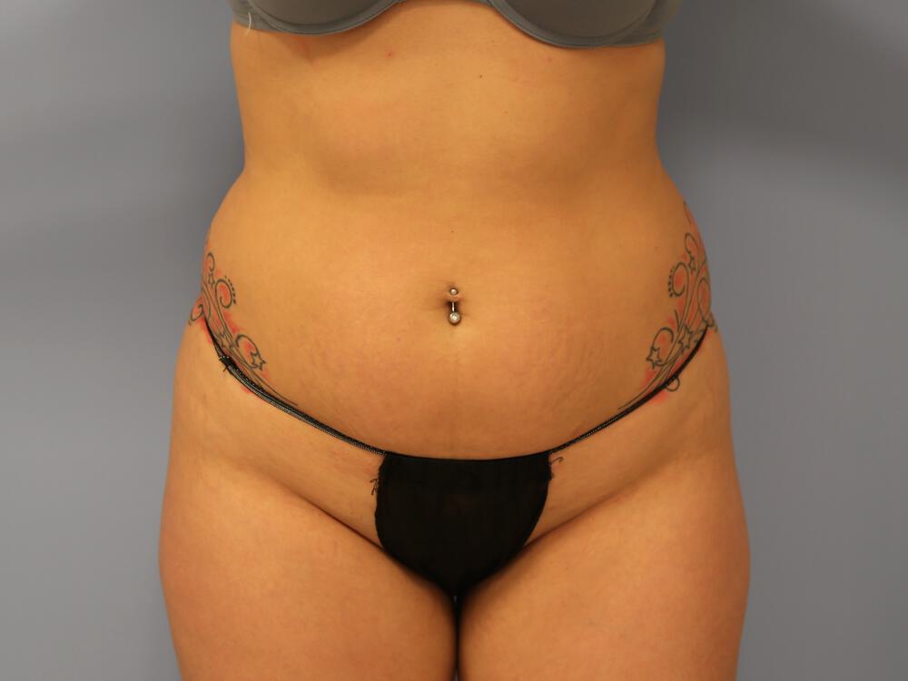 Buttocks Reshaping Before & After Image
